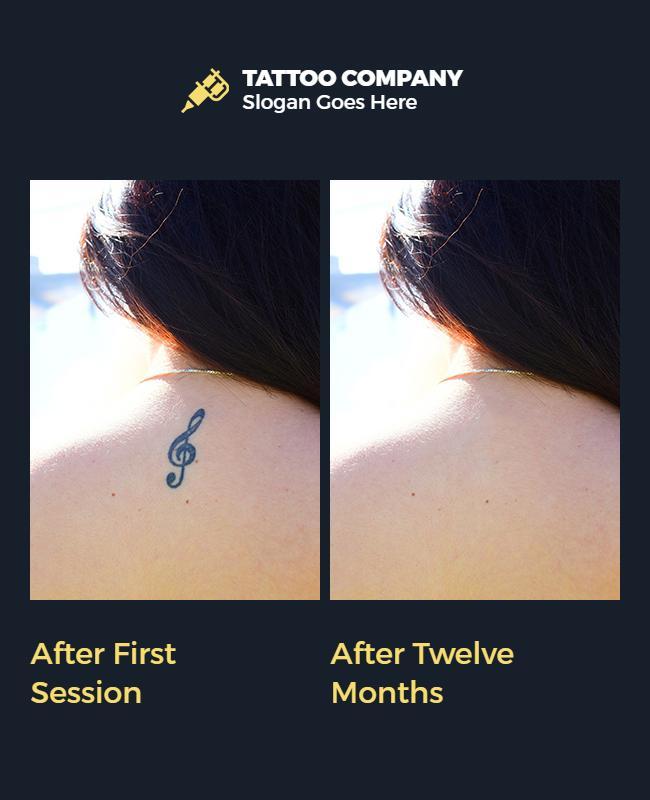 Tattoo Removal Service Comparison Flyer Template