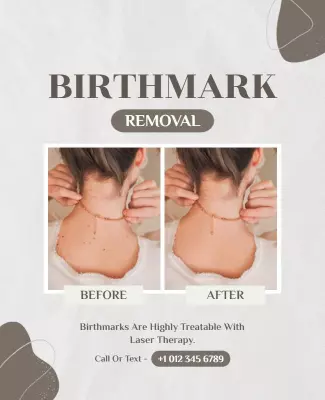 Laser Treatment Birthmark Removal Flyer Template