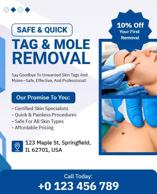Skin Tag and Mole Removal Service Flyer Template